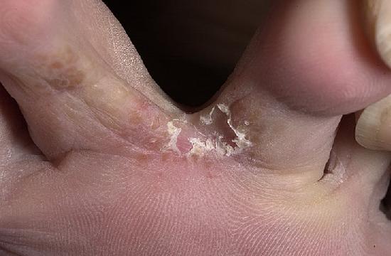грибок между пальцами ног чем лечить